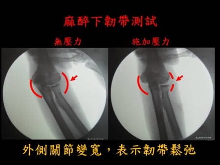 elbow-fx-dislocation (2)