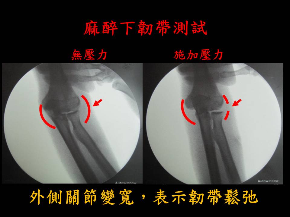 微型錨釘修補斷裂韌帶 不穩定型肘關節脫臼 台中骨科蔡依樽醫師 親切 專業 更用心