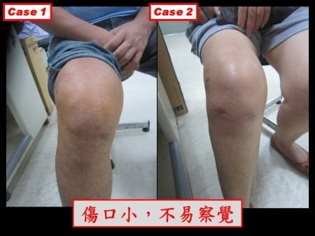 septic-knee (4)