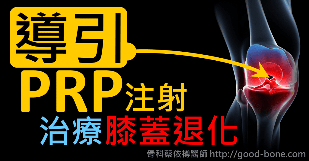 超音波導引PRP 注射治療雙膝蓋退化疼痛關節炎｜疼痛注射專家、超音波導引PRP增生治療、專業骨科推薦｜台中骨科蔡依樽醫師https://good-bone.com