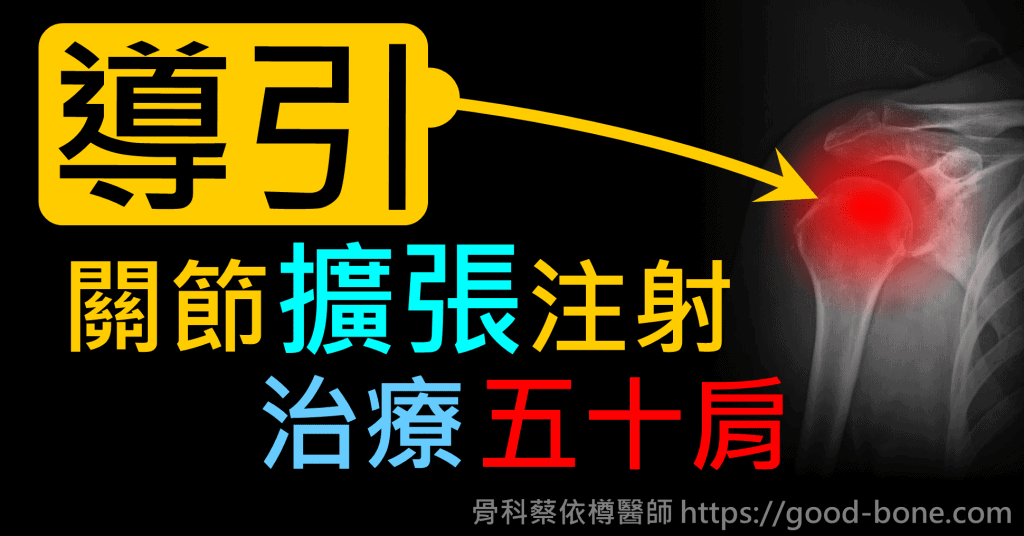 超音波導引關節擴張注射治療五十肩肩膀疼痛沾黏｜專業骨科推薦｜台中骨科蔡依樽醫師https://good-bone.com