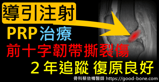 【超音波導引PRP注射治療前十字韌帶撕裂傷，兩年後核磁共振追蹤恢復良好】｜｜｜疼痛注射專家、超音波導引PRP自體血小板血漿Arthrex ACP增生治療、羊膜.絨毛膜AmnioFix注射、葡萄糖增生注射治療、五十肩關節擴張注射治療、板機指/扳機指微創治療手術、SportVis肌腱韌帶撕裂玻尿酸注射、網球肘、高爾夫球肘、媽媽手、膝蓋退化、腰背疼痛、頸椎疼痛、坐骨神經、專業骨科推薦｜台中骨科蔡依樽醫師https://good-bone.com