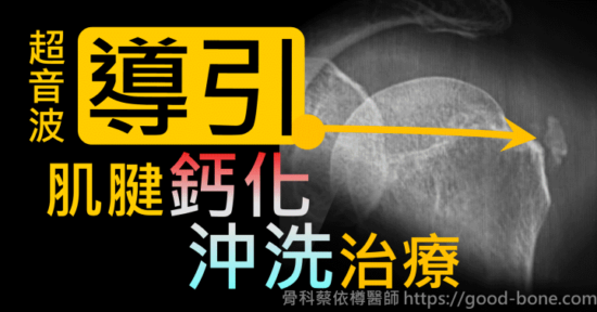 【超音波導引肌腱鈣化沖洗治療】｜｜｜疼痛注射專家、超音波導引PRP自體血小板血漿Arthrex ACP增生治療、羊膜.絨毛膜AmnioFix注射、葡萄糖增生注射治療、五十肩關節擴張注射治療、板機指/扳機指微創治療手術、SportVis肌腱韌帶撕裂玻尿酸注射、網球肘、高爾夫球肘、媽媽手、膝蓋退化、腰背疼痛、頸椎疼痛、坐骨神經、專業骨科推薦｜台中骨科蔡依樽醫師https://good-bone.com